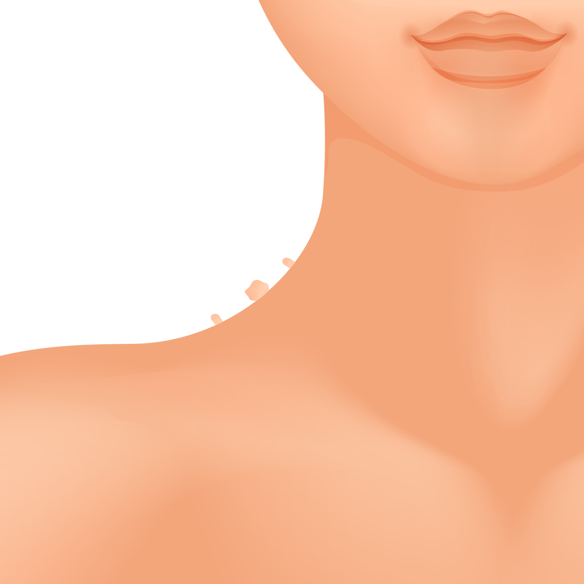Skin Tags