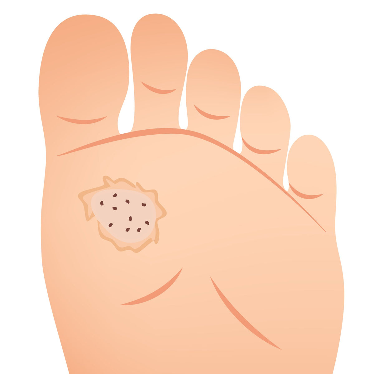 Warts
